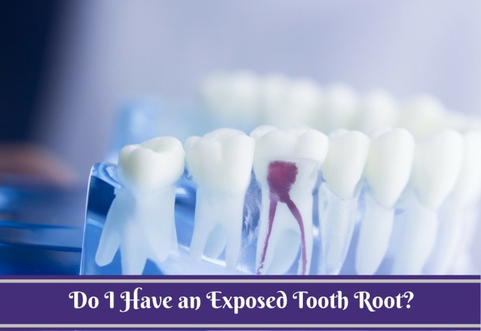 How To Treat Exposed Tooth Root? Treat an Exposed Tooth Root