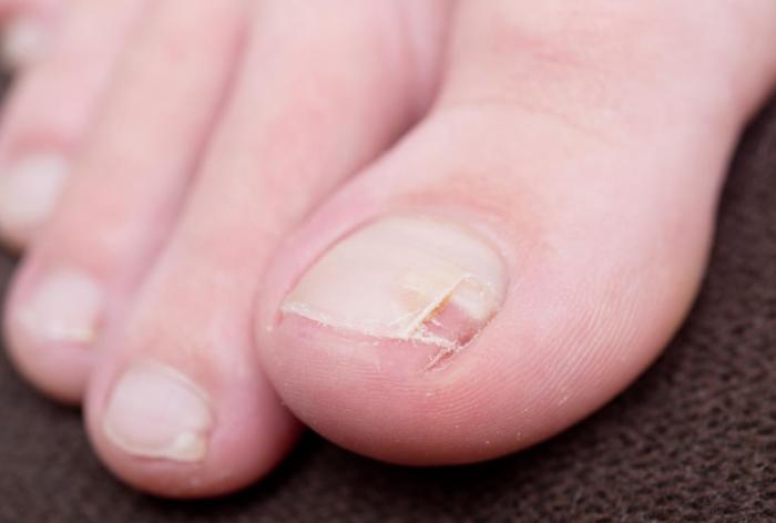 Treat a Torn Toenail A Comprehensive Guide