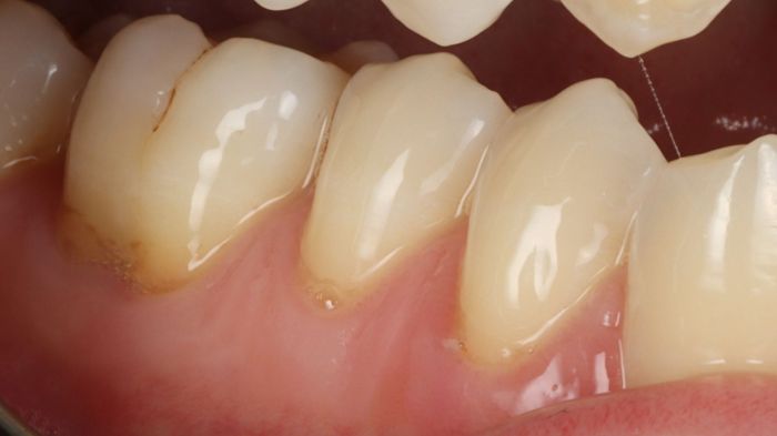 Treat an Exposed Tooth Root