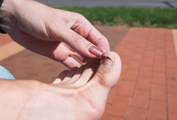 Treat a Torn Toenail